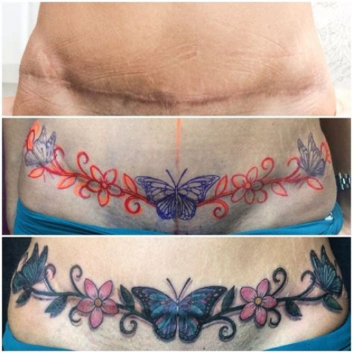 Tattoo Ideas for Tummy Tuck Scars Tattoo Ideas for Tummy Tuck Scars
